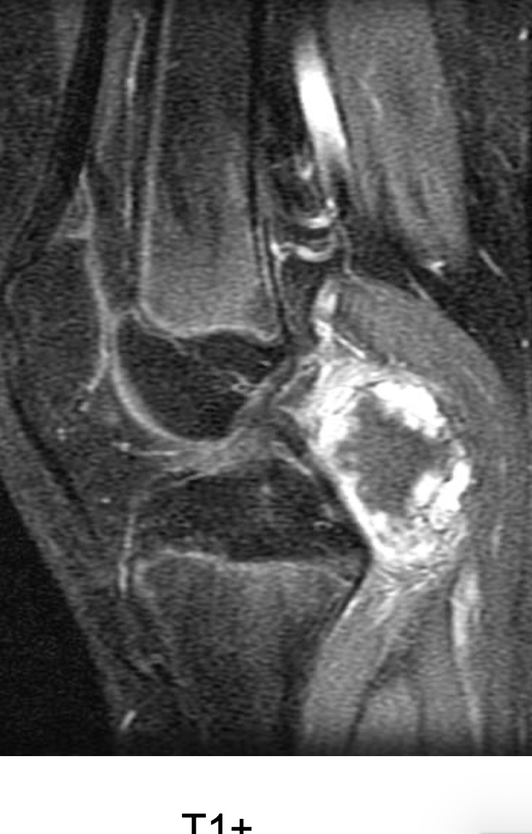 Figure 3 for case Synovial chondromatosis